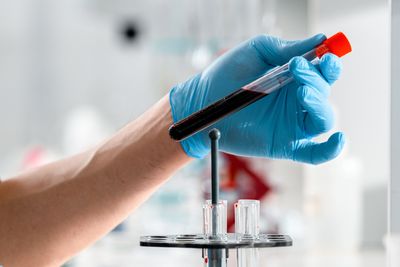 A Drug That Could Functionally Cure Hepatitis B Achieved That Goal in 1 in 5 Patients in Two Major Phase 3 Trials