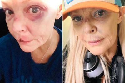 Gail Porter reveals grisly injuries after being ‘knocked over’ in London