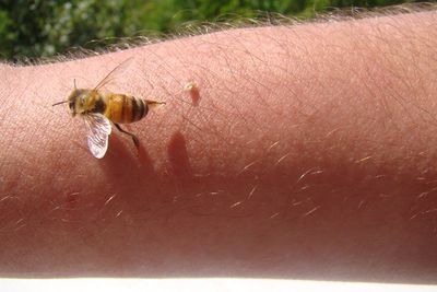Woman turns to bee venom therapy to treat Lyme disease symptoms