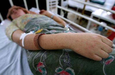 CDC Data Show Seven States Carry Most 2026 Measles Cases as National Total Reaches 2,318