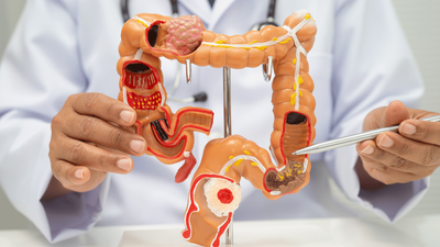 Doctor explains why colon cancer is rising in adults in their 30s—and why a 45-minute gym session isn't enough