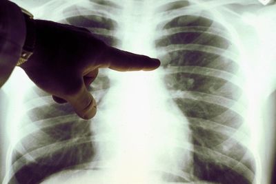 Machine that keeps lungs alive outside the body set for NHS use