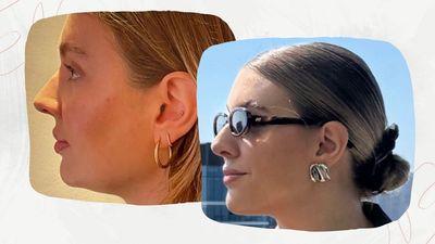 This non-invasive treatment completely transformed my jawline – and I’m ready to share all the details