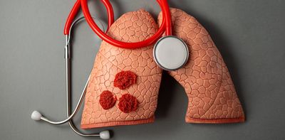 Hundreds of people in England died before doctors diagnosed their tuberculosis
