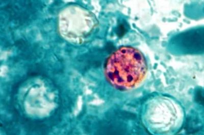 Brits warned about ‘explosive diarrhoea’ cyclospora infection