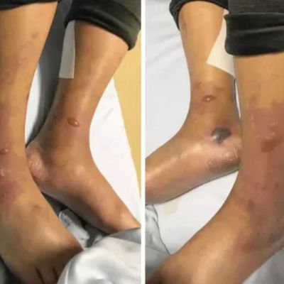 Florida Discloses Its First Vibrio Vulnificus Death of 2026, and the Bacteria Does Not Actually Eat Flesh