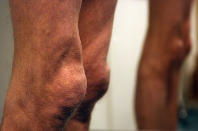 Joint Pain and a Rash Can Be Signs of an Untreated Infection Most People Never Suspect