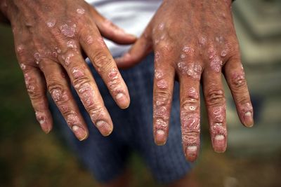 A Psoriasis Cream Is Now Approved for Children as Young as 2, and the Data Behind It Works Differently