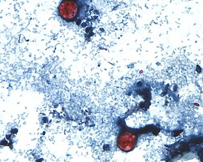 Is the cyclosporiasis outbreak slowing? Test-makers are hopeful