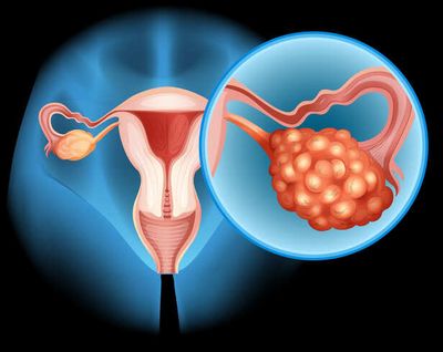 5 Hidden Signs of Ovarian Cancer You Should Never Ignore