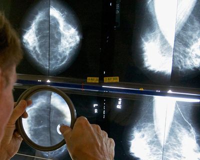 GPs’ breast cancer guidelines ‘miss’ 95% of young women who will develop disease