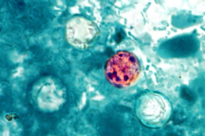 Michigan Cyclosporiasis Outbreak: What Are the Symptoms and Is Taylor Farms Lettuce Safe?