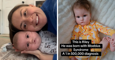 Mom Knew Something Was Wrong When Her Baby Couldn’t Form Expressions, Then Doctors Discovered A Rare Condition