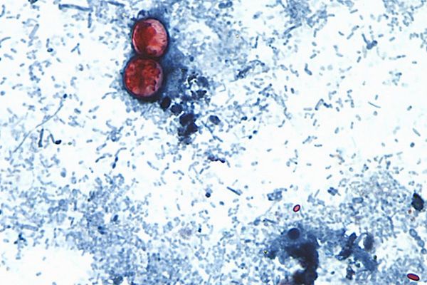 15 states now linked to iceberg lettuce cyclospora outbreak, CDC says