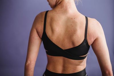 Eczema Patients on Ebglyss Can Stretch Maintenance Shots to Every Eight Weeks, but Only After a Full Induction Course