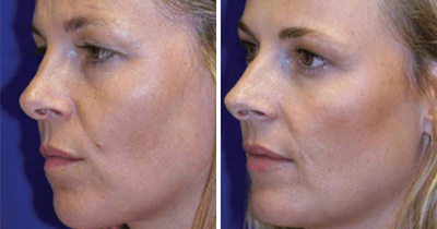 Identical Twins Show Dramatic Differences After One Uses Botox For 20 Years And The Other Doesn’t