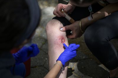 Louisiana Confirms Five Vibrio Vulnificus Deaths, and All Nine Cases Began with a Wound