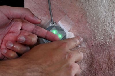 A Wearable Ultrasound Patch Cut Time to REM Sleep by 43 Minutes in a 28 Person Study