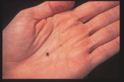 A Tick Bite Can Trigger a Delayed Red Meat Allergy That Routinely Goes Undiagnosed for Years