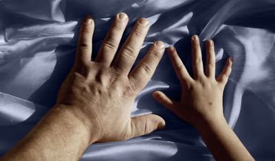 A Photo of Your Hand Could Reveal a Rare Hormone Disorder, and AI Spotted It Better Than 10 Specialists
