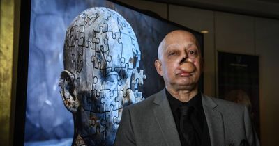 Chris can't afford a prosthesis to mask his scars - and there's no funding to help him get one
