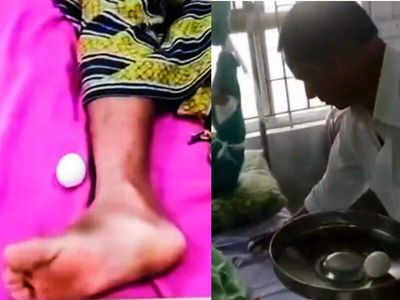 Stanley hospital viral video: Chennai hospital worker leaves boiled eggs besides patients at bed
