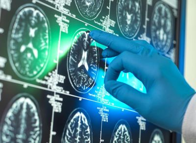 Alzheimer’s research is latest casualty in Trump administration war against ‘DEI’