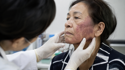 A Strange Rash Stayed on Just One Side of Her Face for 4 Years, Then a Biopsy Revealed a Hidden Disease