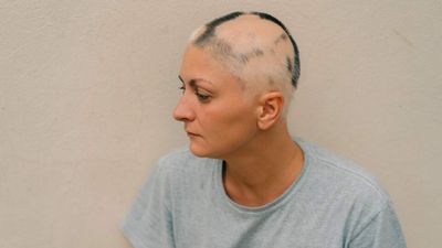 Upadacitinib Reached 80 Percent Scalp Coverage in About Half of Severe Alopecia Areata Patients at 24 Weeks
