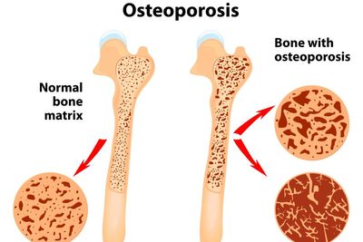 Exercise remains crucial part of bone health