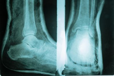 An X-Ray Suggested a Broken Foot but the Player Had Been Carrying That Extra Bone His Whole Life