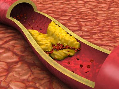 Cardiologists share new guidelines on how to manage cholesterol