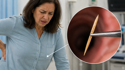 Her Kidney Infections Were Blamed on Fibroids and a Hysterectomy Followed, but a Swallowed Toothpick Was the Cause