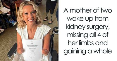 Woman Had Both Legs And Hands Amputated After Routine Surgery, And Her Reaction Moves People