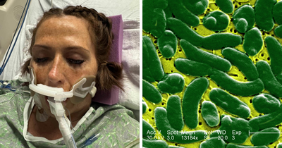 Woman Who Lost ‘A Lot Of My Leg’ To Flesh-Eating Bacteria Warns Women About Common Pre-Swim Habit