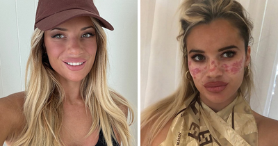 Reality Star Launches Fake Freckle Brand After Attempt At Tattooing Her Own Face For Viral Trend Left Her Scarred