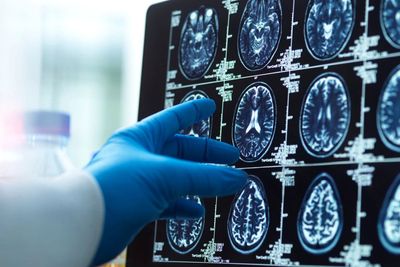 AI used in real time during world-first brain tumour surgery