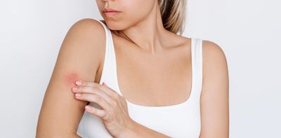 Why do some people react so badly to mosquito bites? The answer lies in mosquito saliva