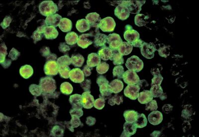 North Carolina teenager dies from rare brain-eating amoeba infection