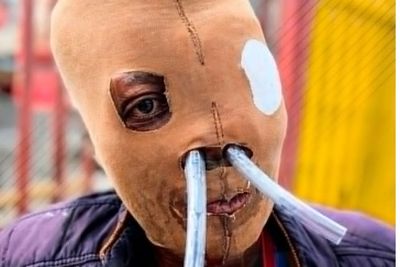 'No One Has Helped Me... I'm Worse': Acid Attack Survivor Seeks Euthanasia After Decades of Pain