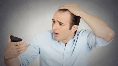 Men Genetically Prone to Baldness Carry a 7 Percent Added Hair Loss Risk Tied to GLP-1 Biology