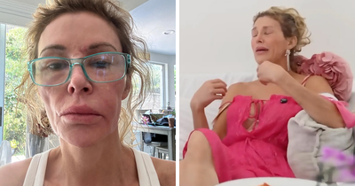 ‘Embarrassed’ Brandi Glanville Breaks Down Over Asking Fans For Money Amid Ongoing Facial Disfigurement