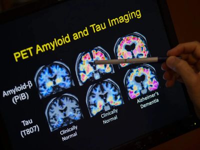 Alzheimer’s may affect more than brain cells — scientists discover DNA’s 3D shape is changing in ways that could reveal hidden causes of memory loss