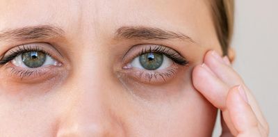 ‘Ferritin face’ is trending – but can your skin really reveal low iron?