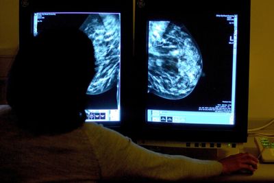 Young women who are overweight may be less likely to develop breast cancer