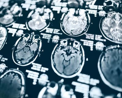 Hundreds of ageing Americans may not get results of Alzheimer’s study due to Trump cuts