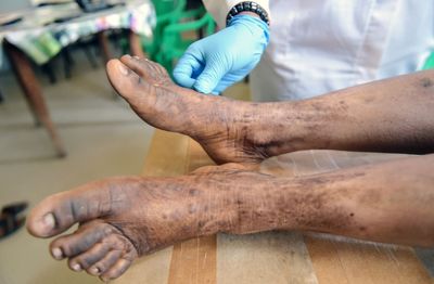Dry January Cleared a Woman's Stubborn Leg Rash, Pointing Doctors to a Rare Alcohol-Linked Vasculitis