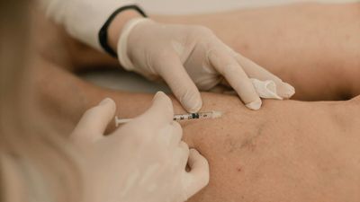 Varices et insuffisance veineuse : peut-on prévenir les troubles veineux?