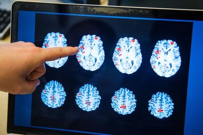 New DNA test cuts brain tumour diagnosis times from ‘weeks to days’