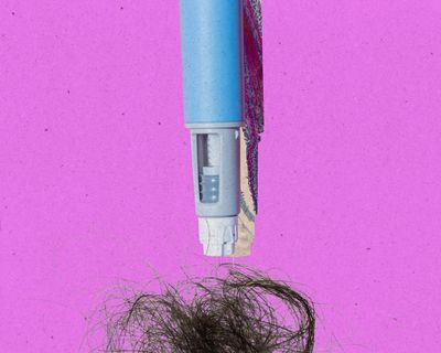 Does GLP-1 use result in significant hair loss?
